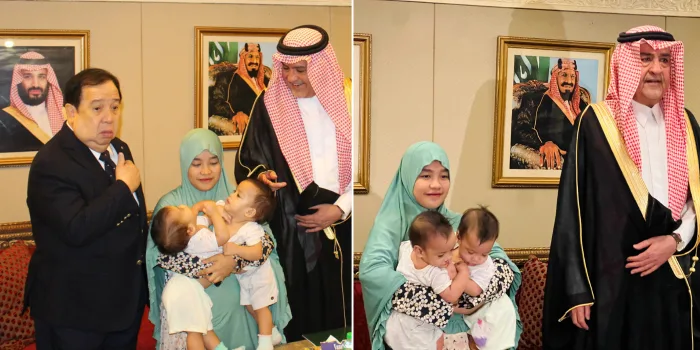 السعودية في طريق إنقاذ توأم سيامي جديد